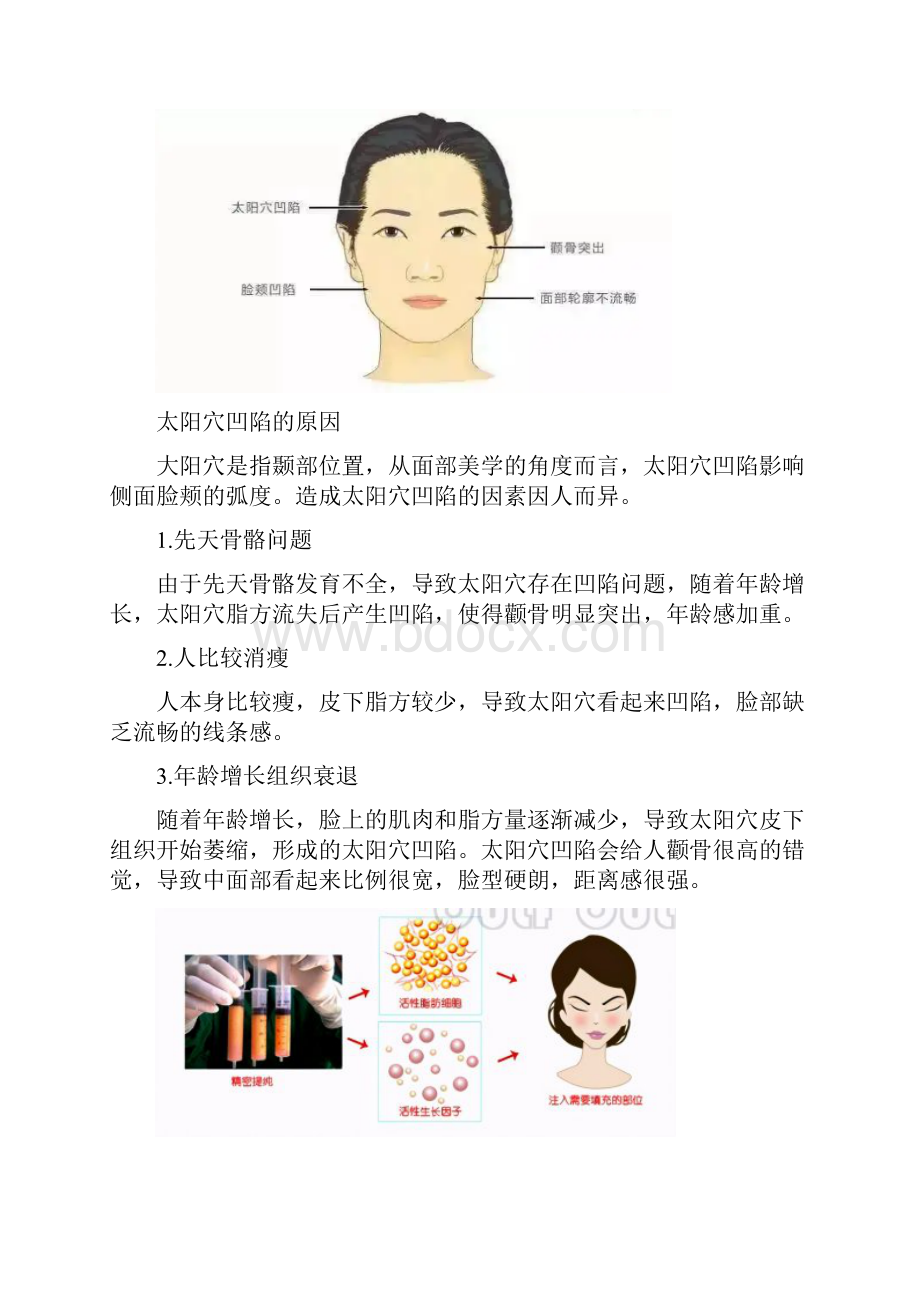 太阳穴填充前一问自体脂肪丰太阳危险吗常见问题解答.docx_第2页