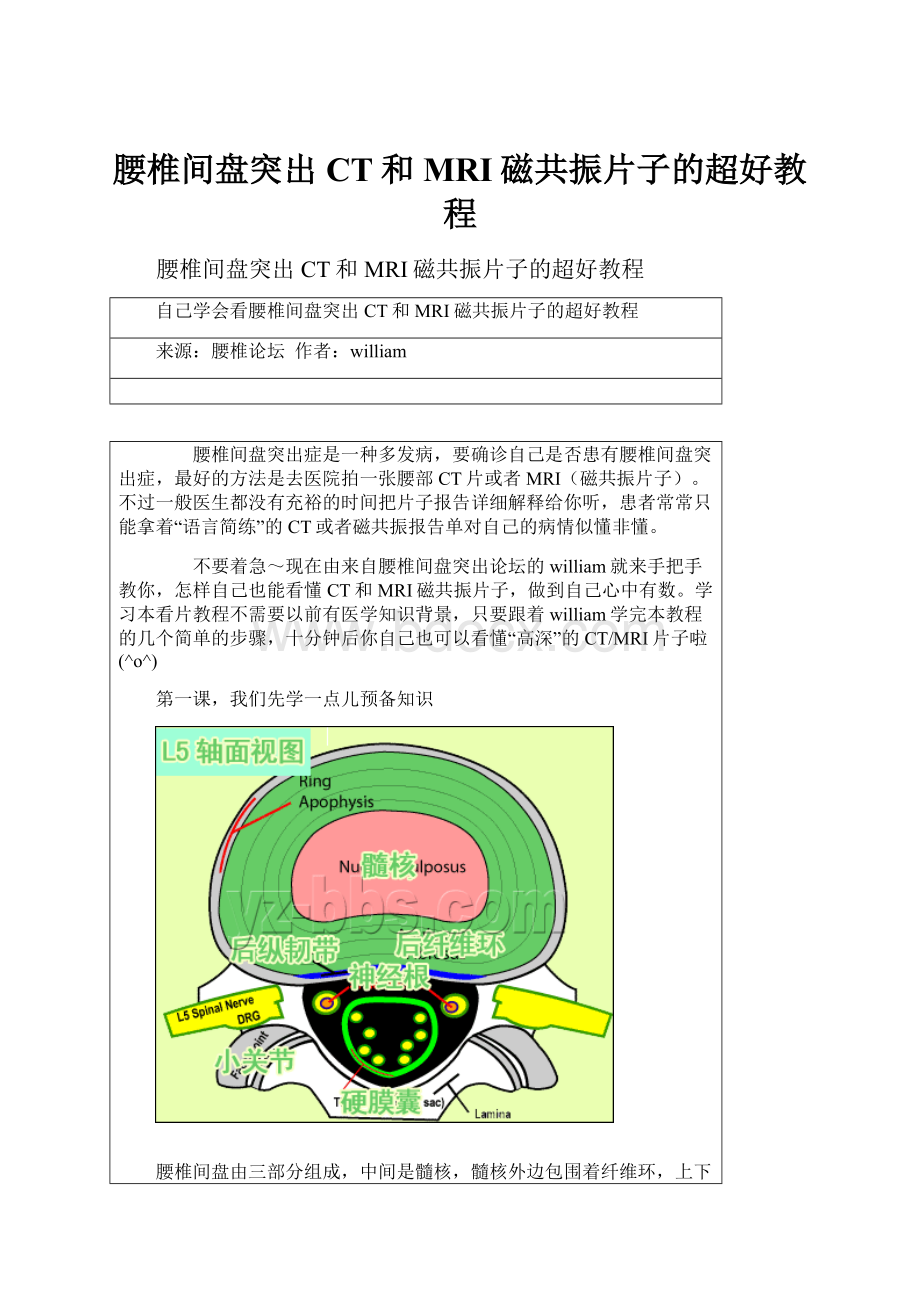 腰椎间盘突出CT和MRI磁共振片子的超好教程.docx_第1页