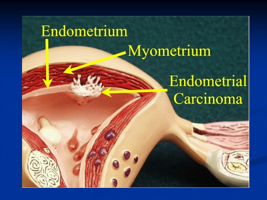 子宫内膜癌课件.ppt_第3页