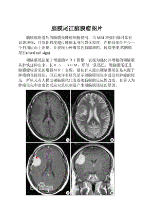 脑膜尾征脑膜瘤图片.docx