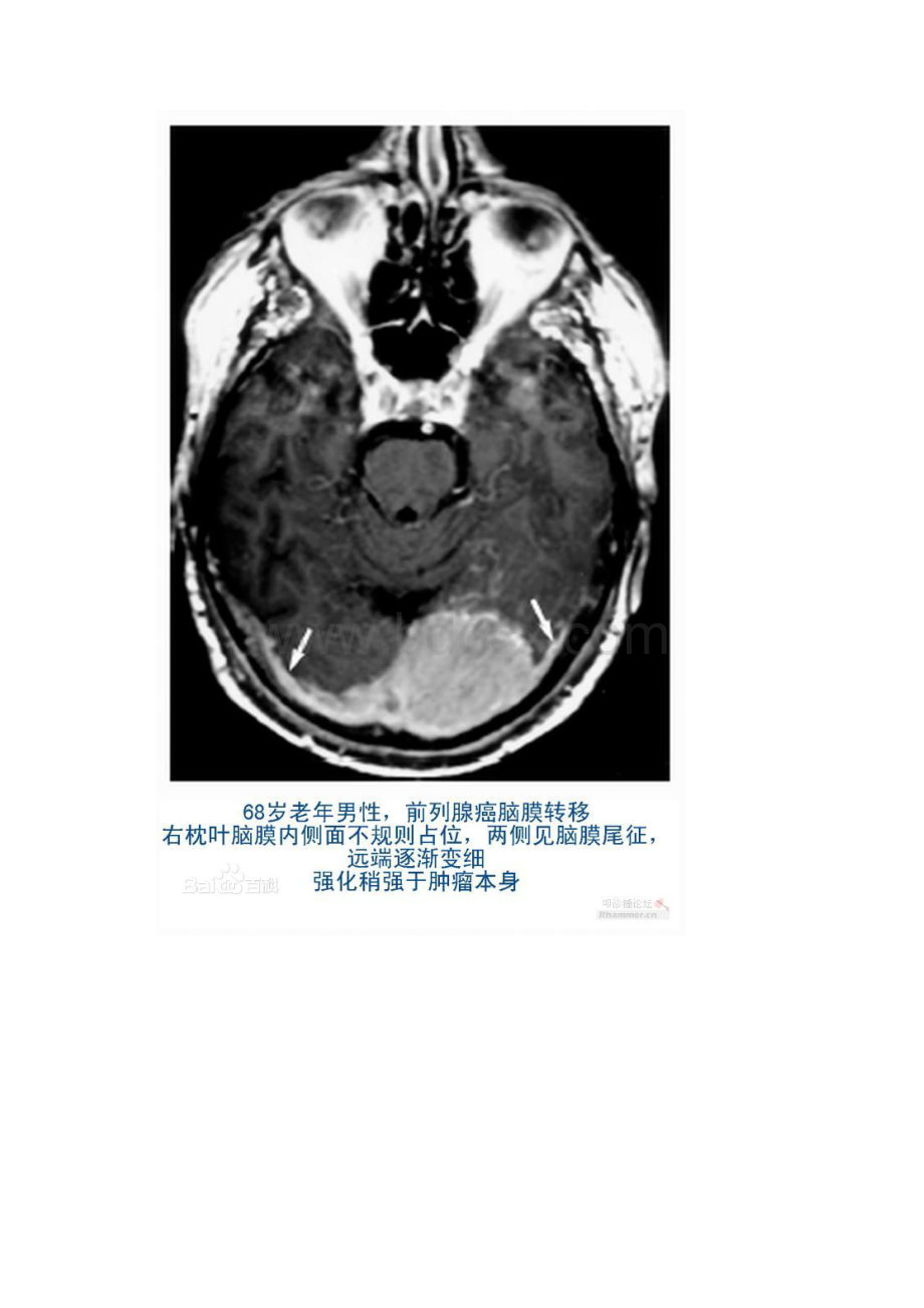 脑膜尾征脑膜瘤图片.docx_第2页