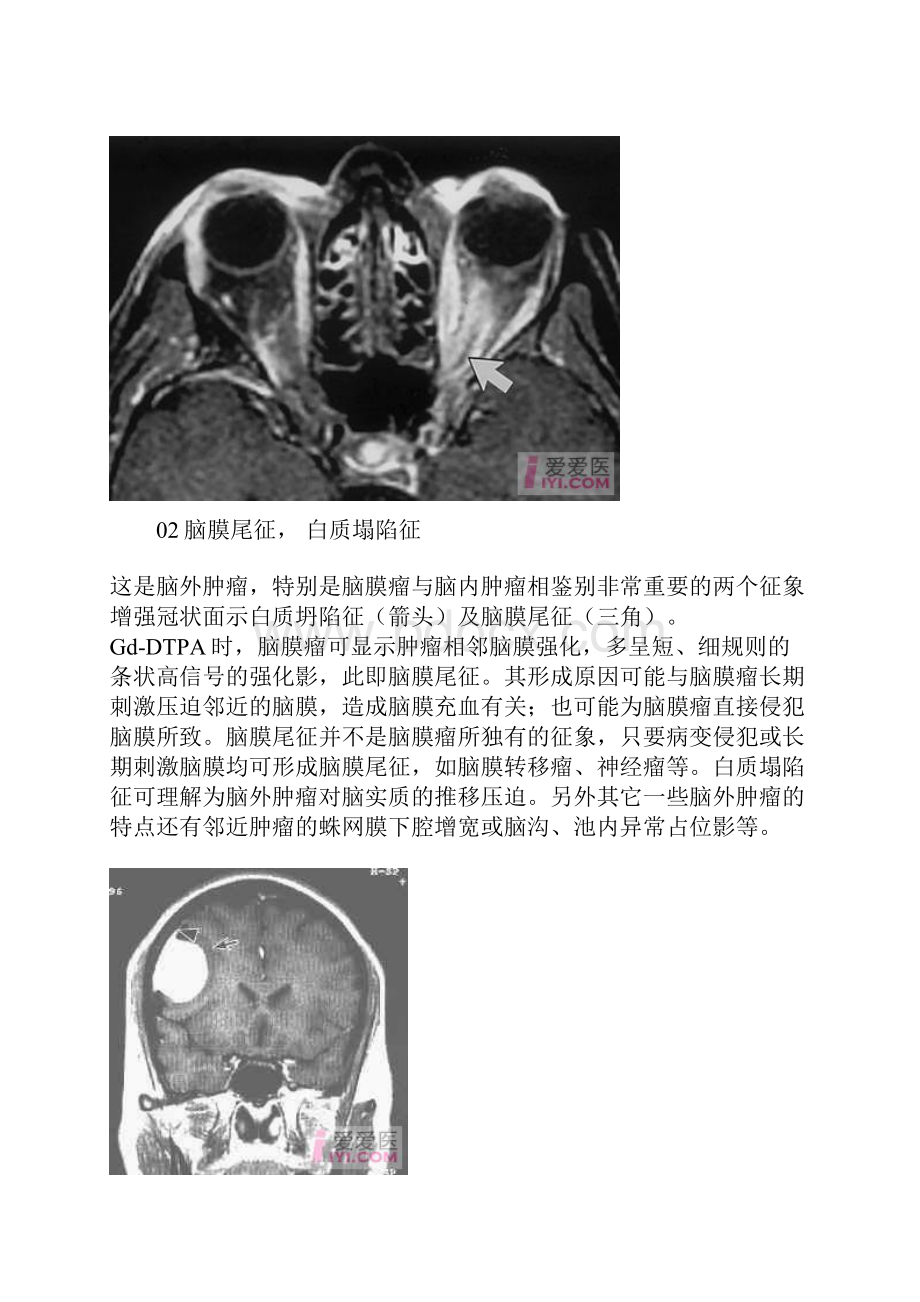 医学影像学各种征象综合.docx_第2页