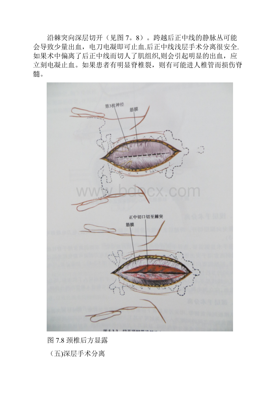 颈椎后路手术.docx_第3页