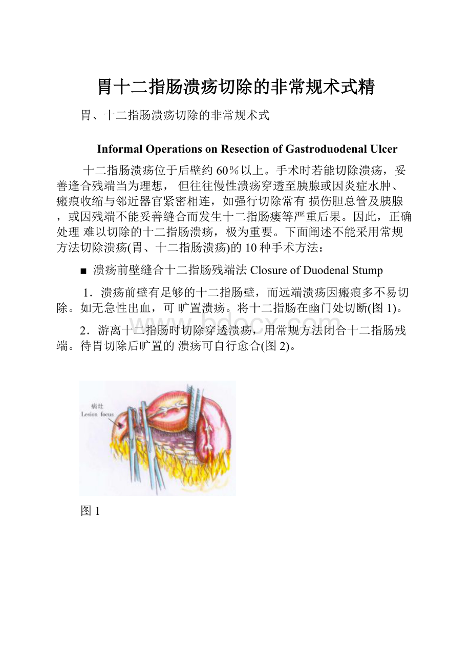 胃十二指肠溃疡切除的非常规术式精.docx_第1页