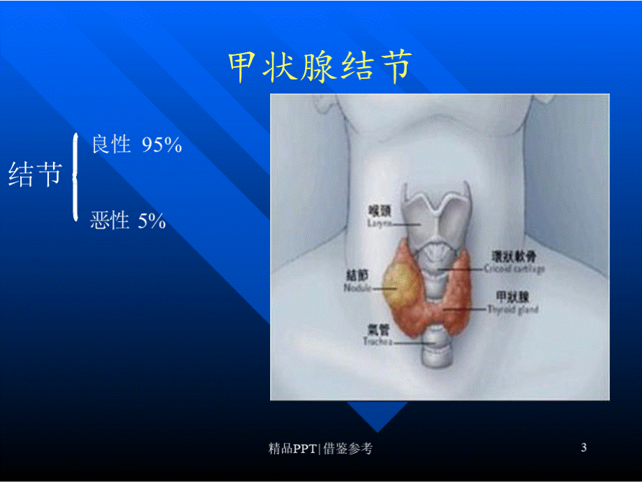 科普-甲状腺结节[宣讲].pptx_第3页