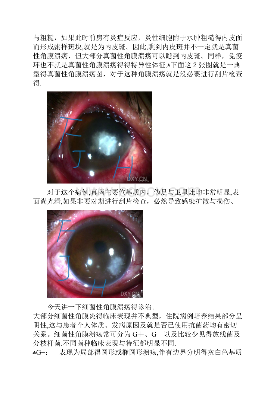 如何正确区别角膜炎的类型.docx_第3页