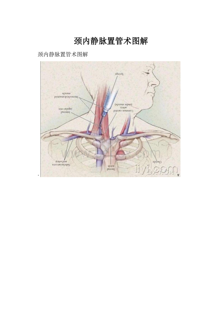 颈内静脉置管术图解.docx