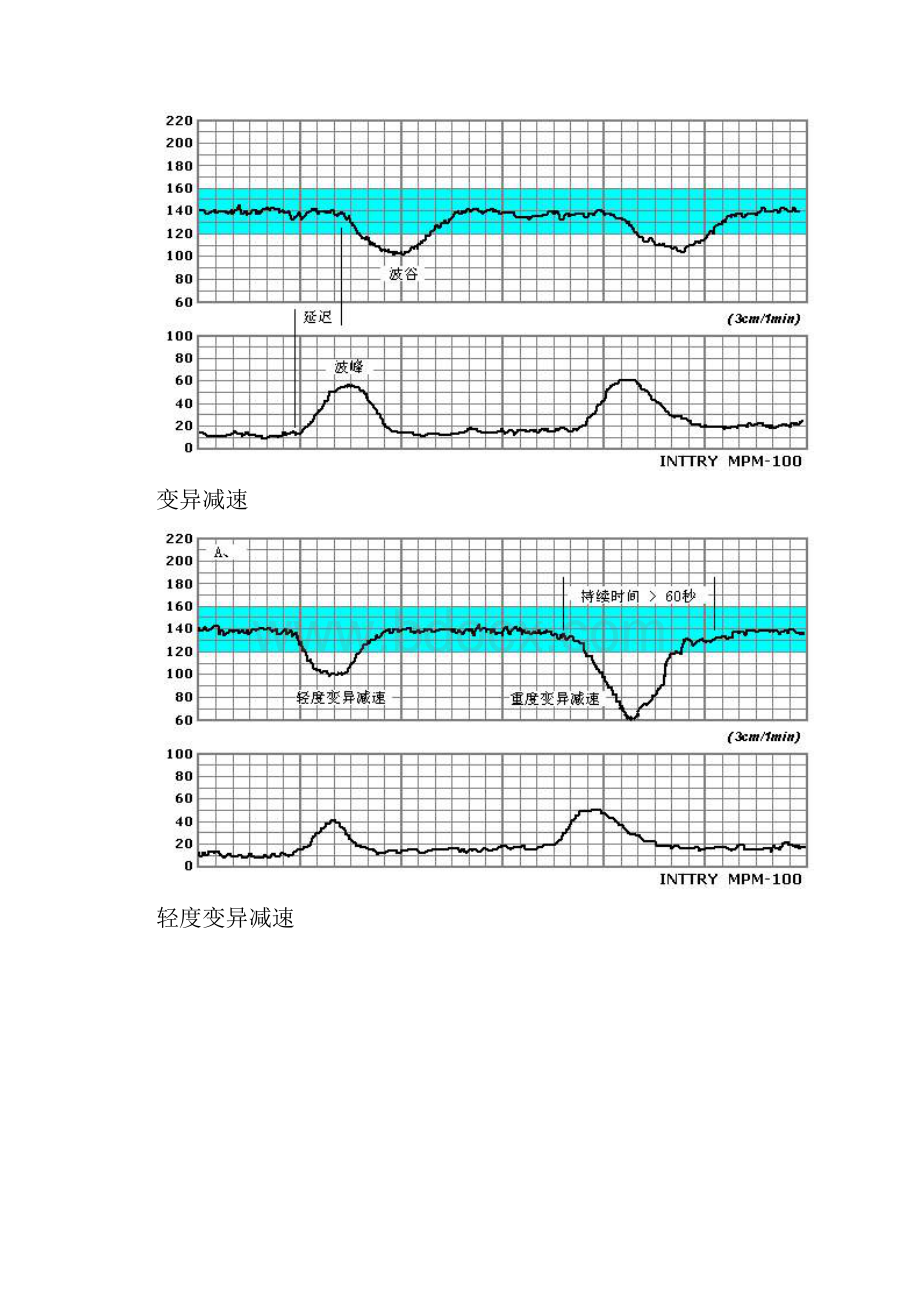 胎心监护图谱精品文档.docx_第3页