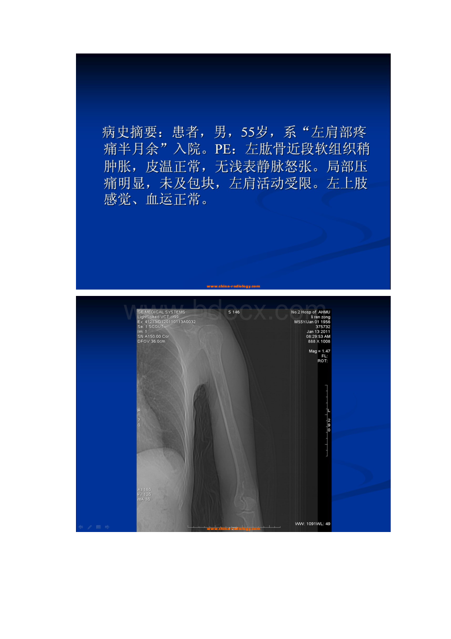 骨纤维结构不良已自动恢复.docx_第3页