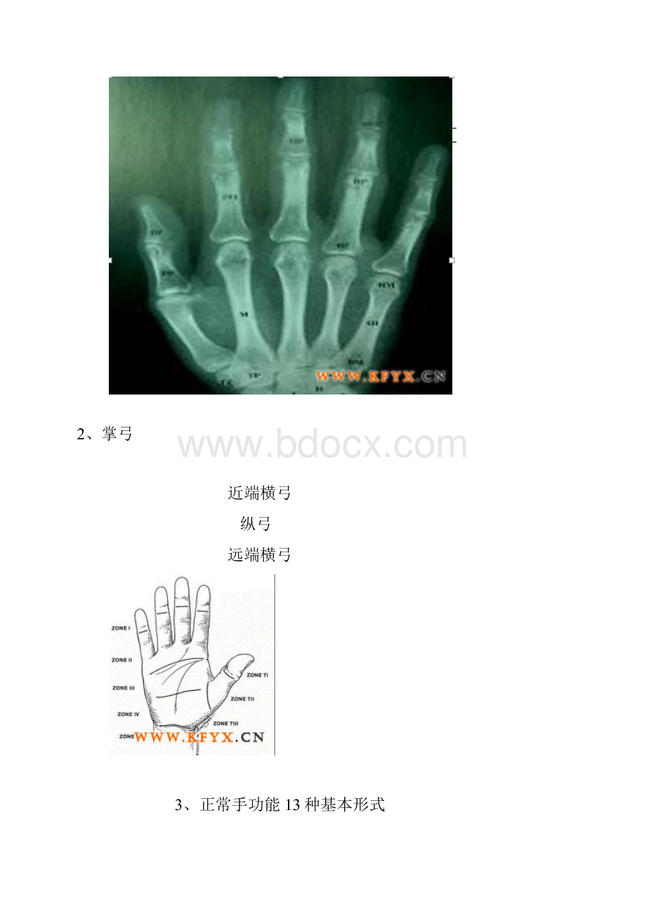 脑瘫儿童上肢功能障碍的康复手技分享.docx_第3页