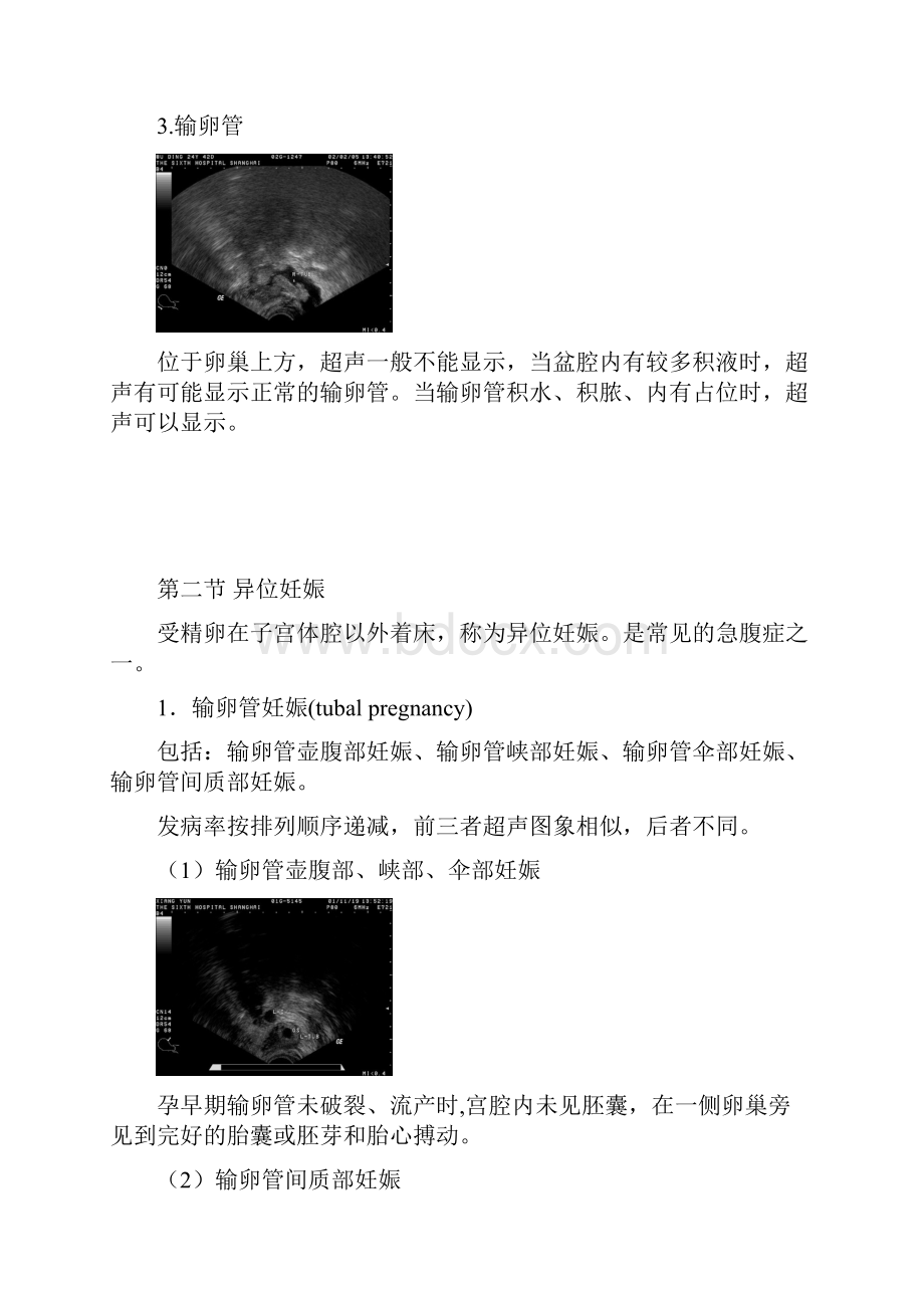 超声诊断学教程第六章子宫及其附件疾病超声诊断.docx_第2页