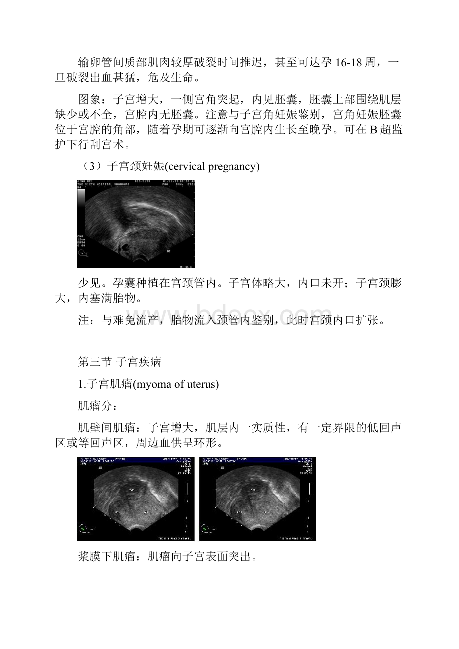 超声诊断学教程第六章子宫及其附件疾病超声诊断.docx_第3页