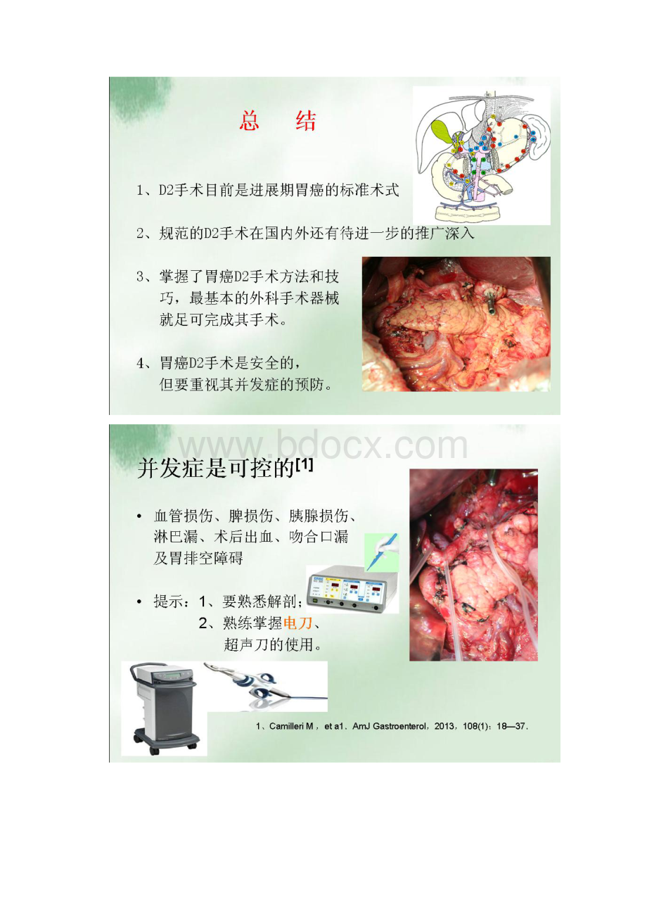 规范胃癌D2手术现状及基本要求.docx_第2页