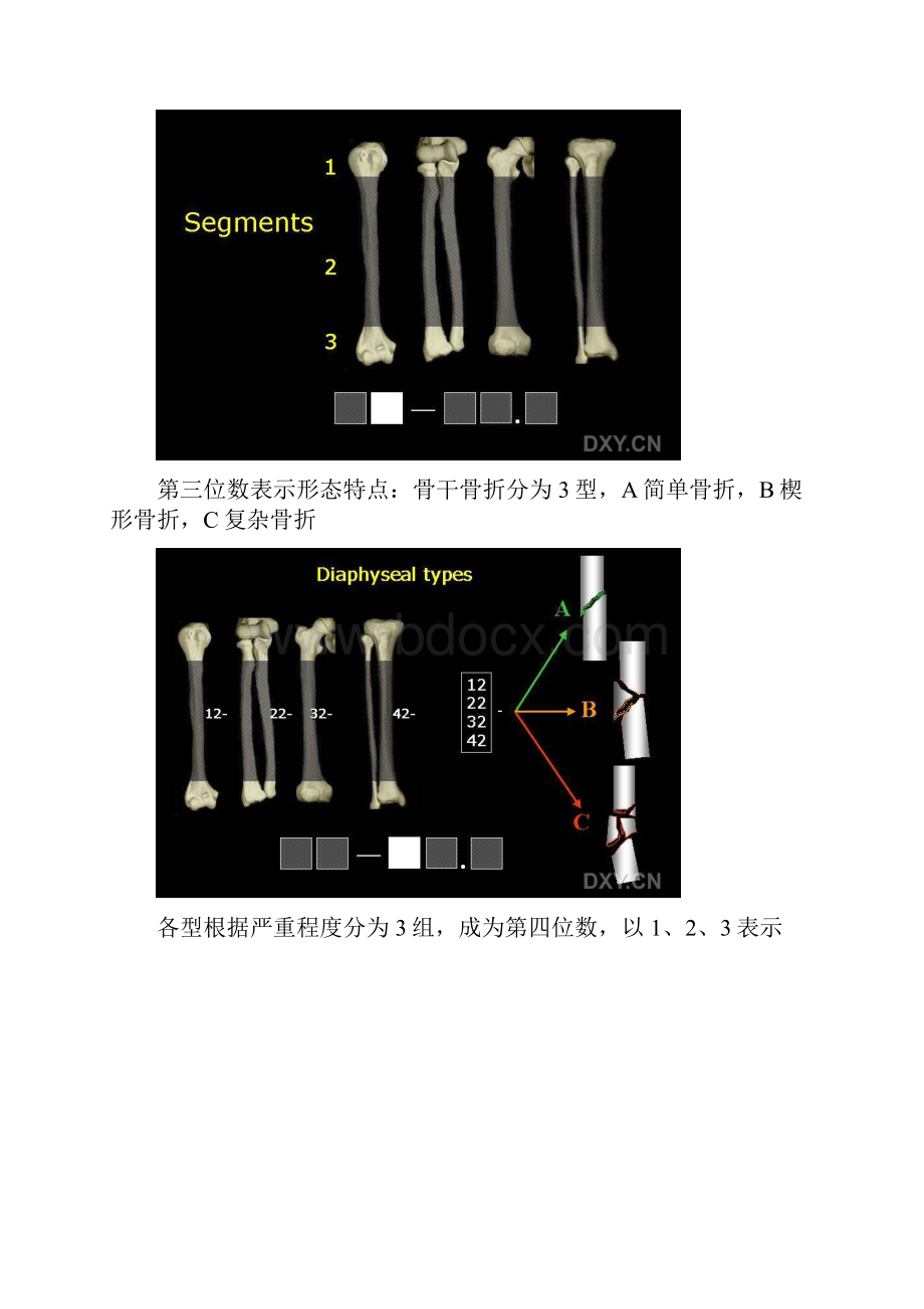 AO分型详细图文解说.docx_第2页