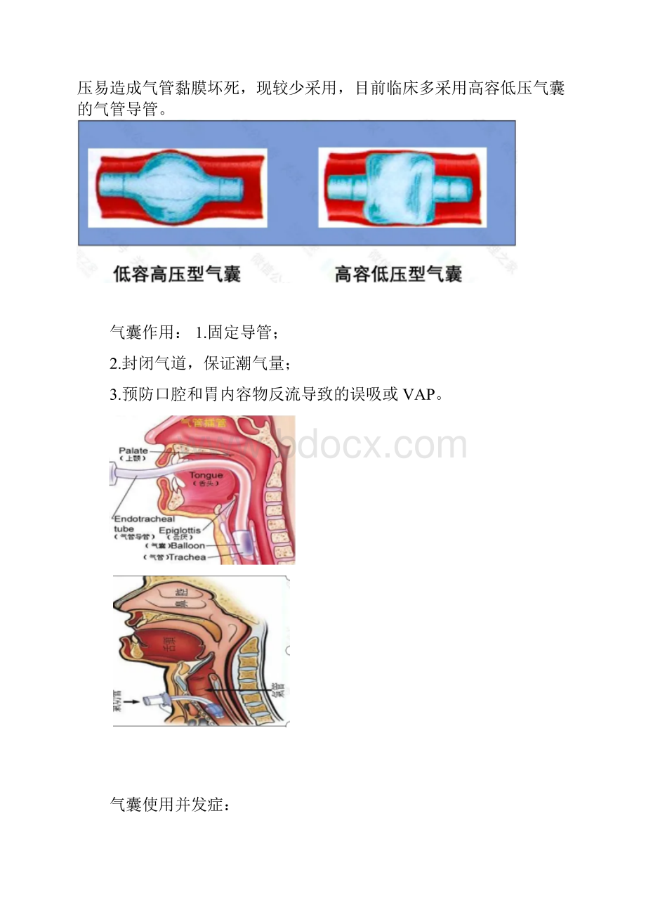 人工气道气囊管理及监测方法.docx_第2页