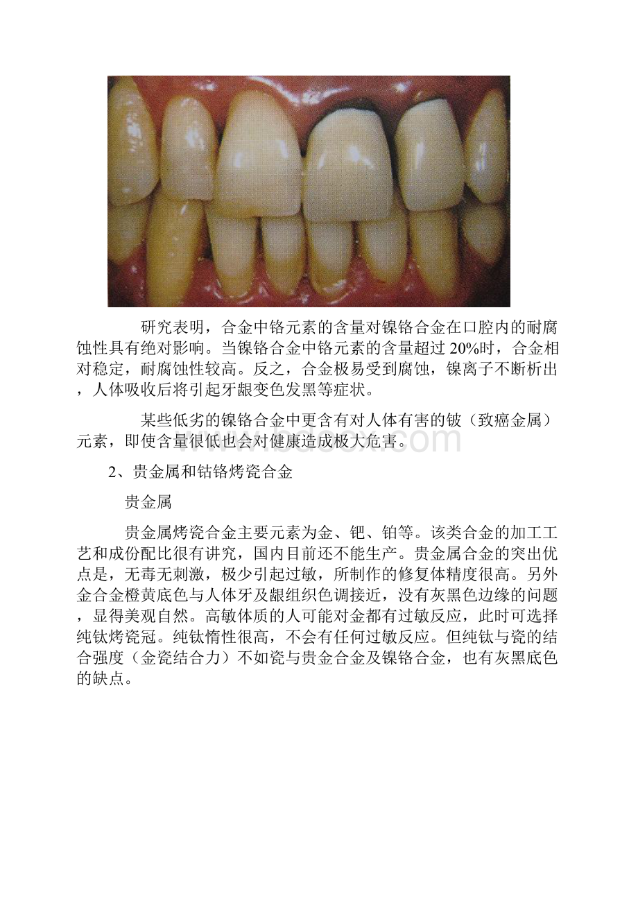 镍铬烤瓷钴铬烤瓷贵金属烤瓷全瓷牙的区别教学文案.docx_第3页