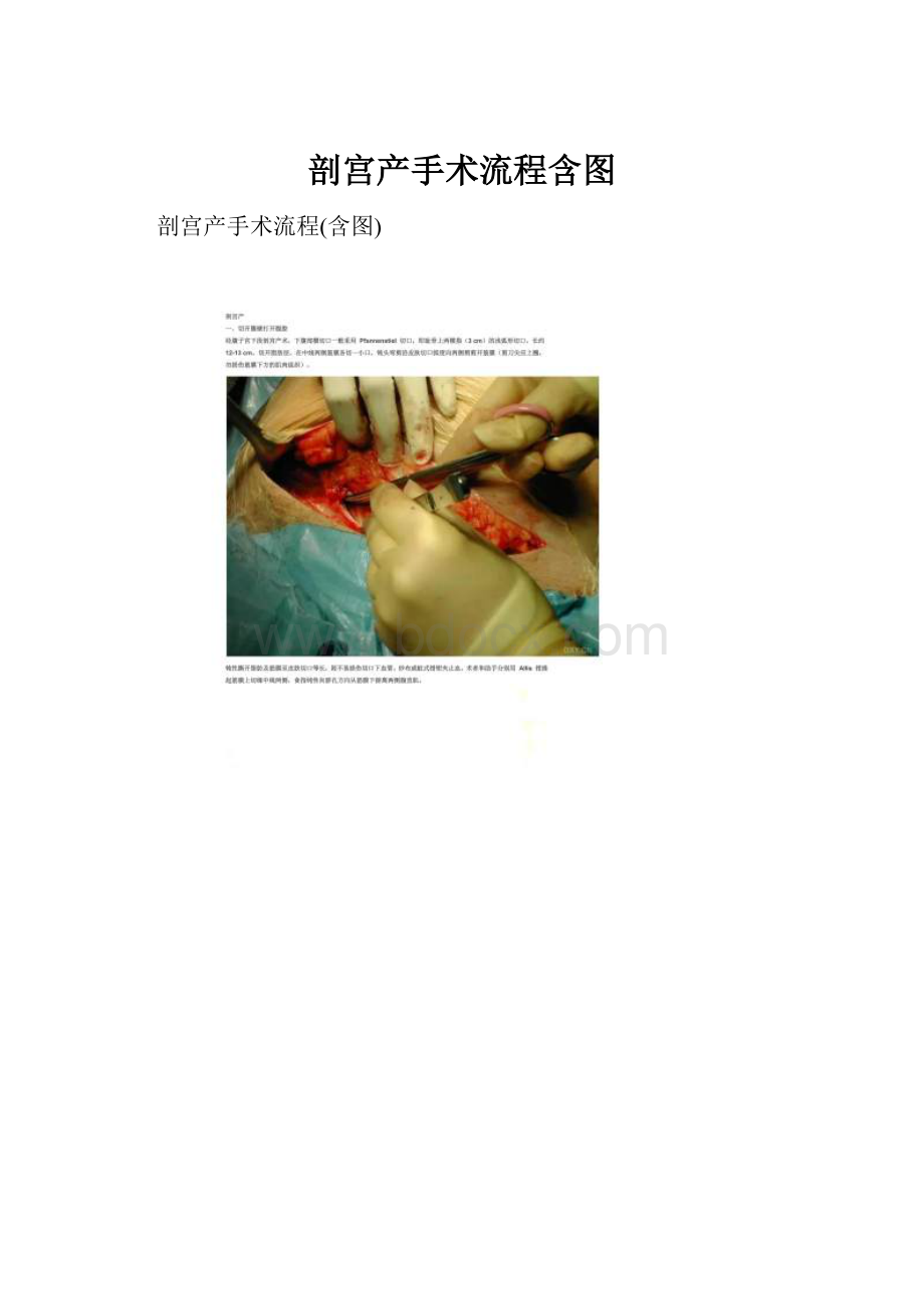 剖宫产手术流程含图.docx