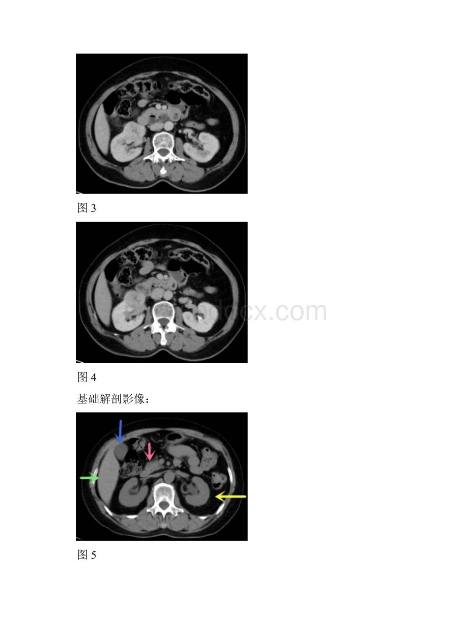 右肾下极中等强化中心条形低密度影占位病变肾嗜酸细胞瘤.docx_第2页