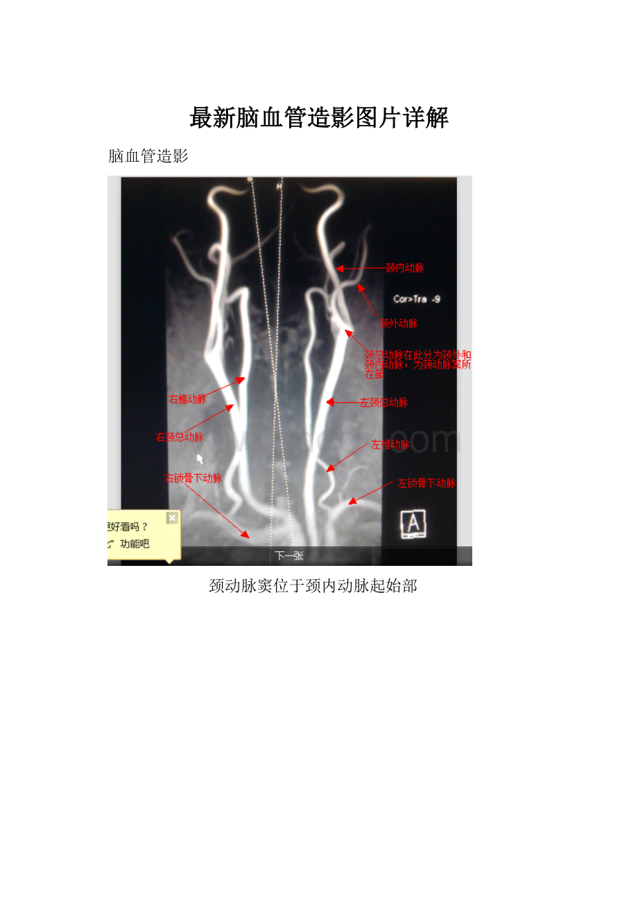 最新脑血管造影图片详解.docx_第1页