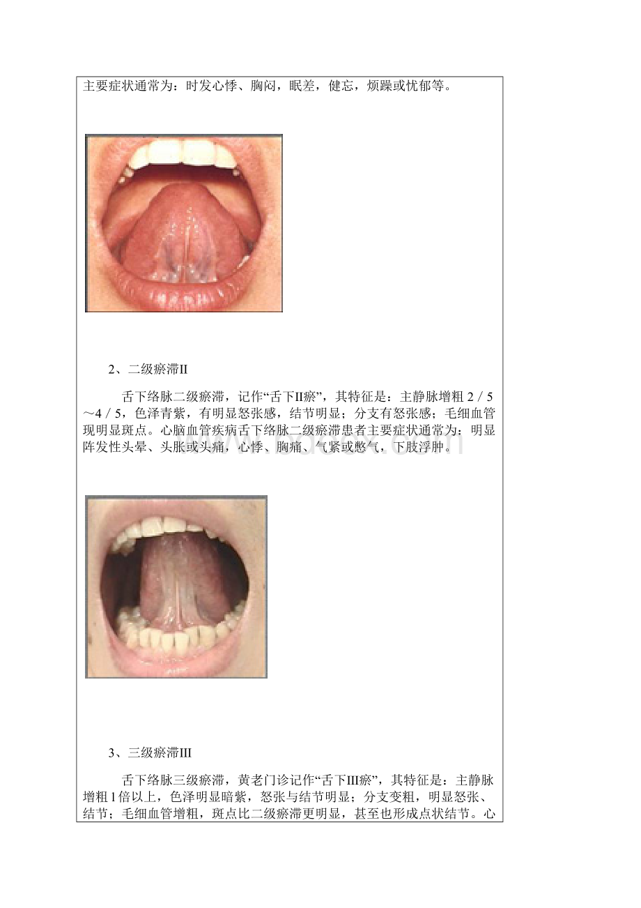 舌下络脉瘀络.docx_第3页