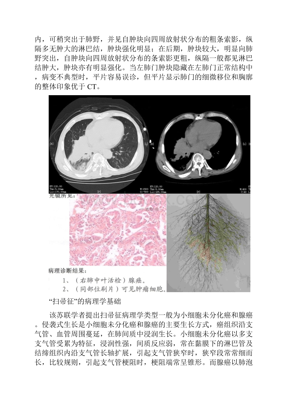 常见胸部影像学征象解析.docx_第3页