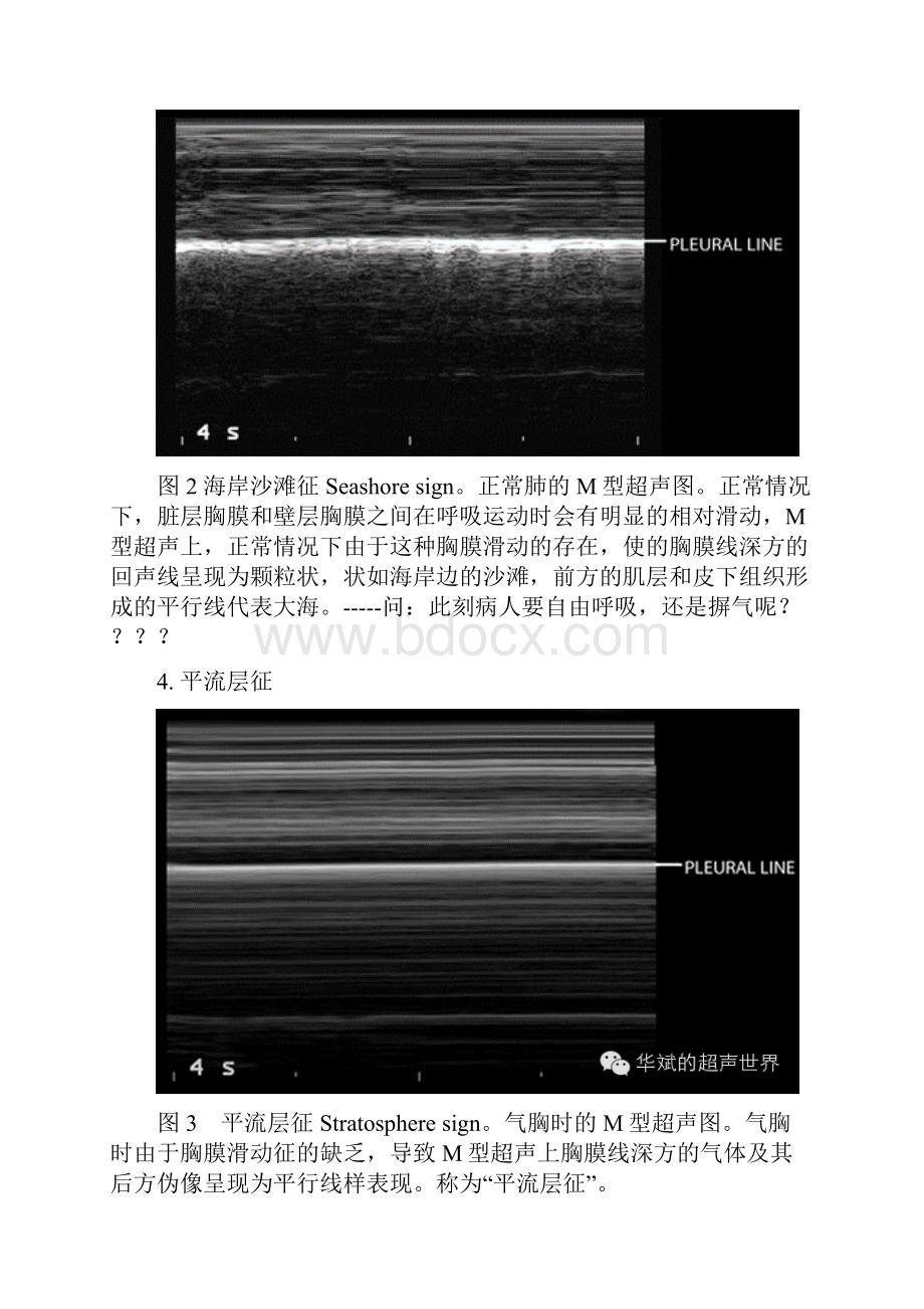 肺部超声一些常见形象征象地解释.docx_第2页