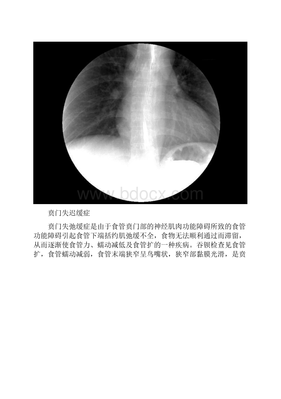 5分钟读懂消化道造影片食管篇.docx_第2页