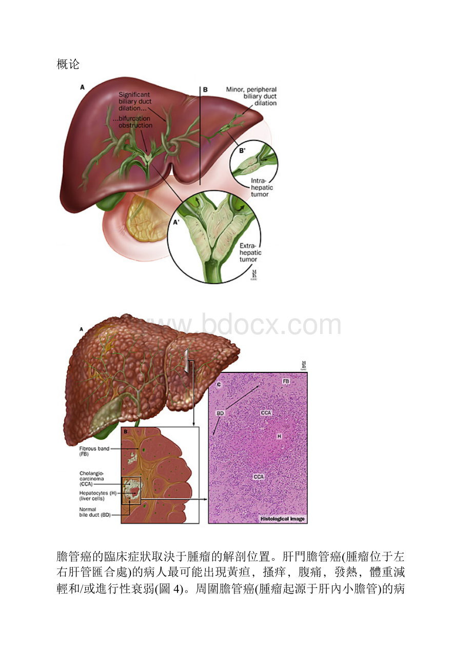 胆管癌精美图解.docx_第2页