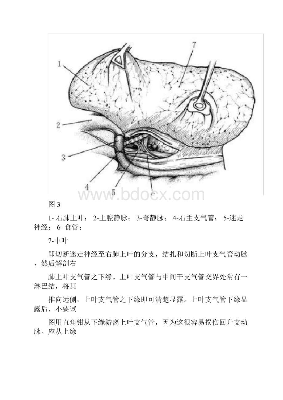 肺叶切除术.docx_第3页