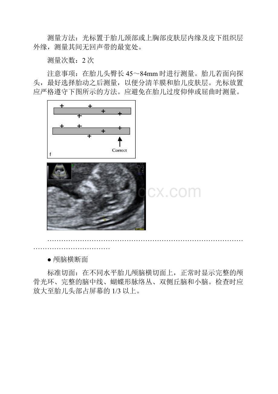 胎儿标准测量切面剖析.docx_第2页