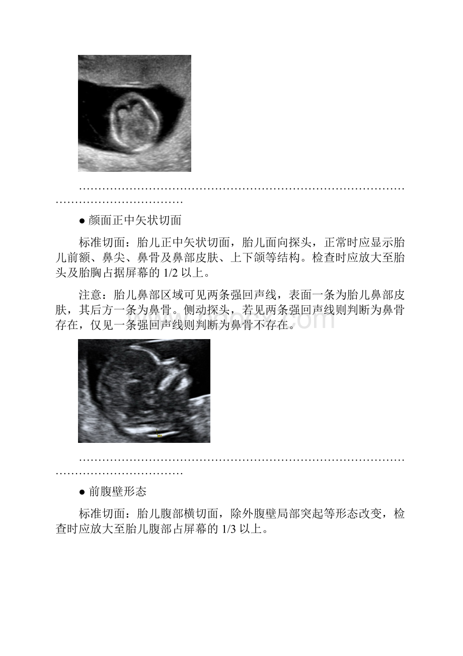 胎儿标准测量切面剖析.docx_第3页