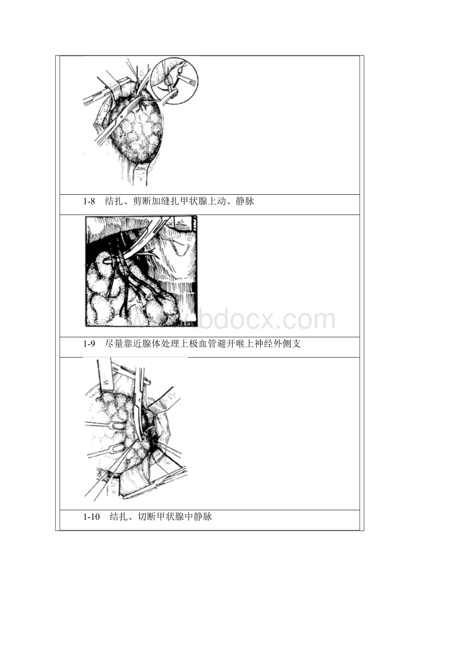 第七课甲状腺次全切除术手术图谱.docx_第3页