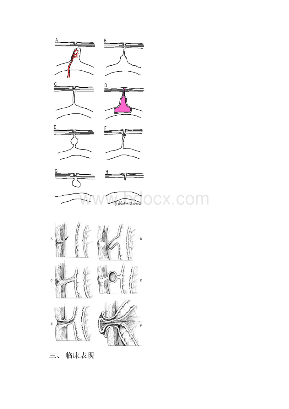 卵黄管残留畸形.docx_第3页