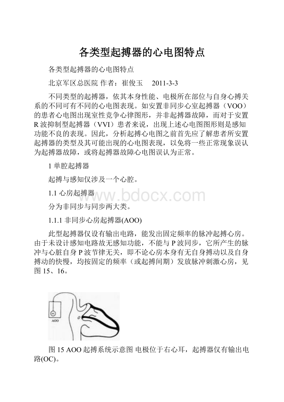 各类型起搏器的心电图特点.docx