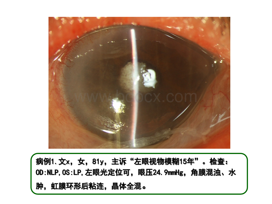 合并青光眼的白内障手术.ppt_第3页